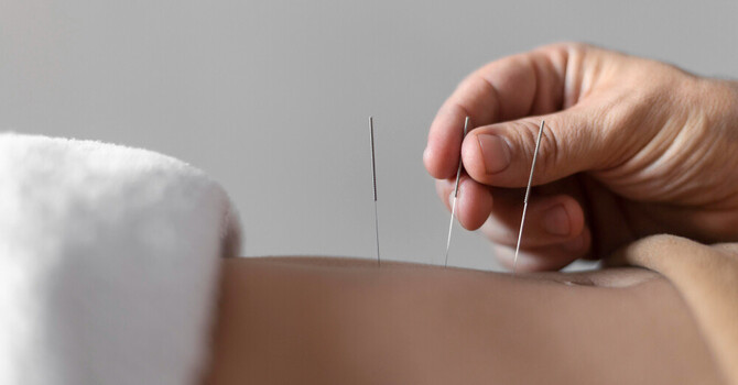 Acupuncture for Pain Relief | Powerful Proven Healing image