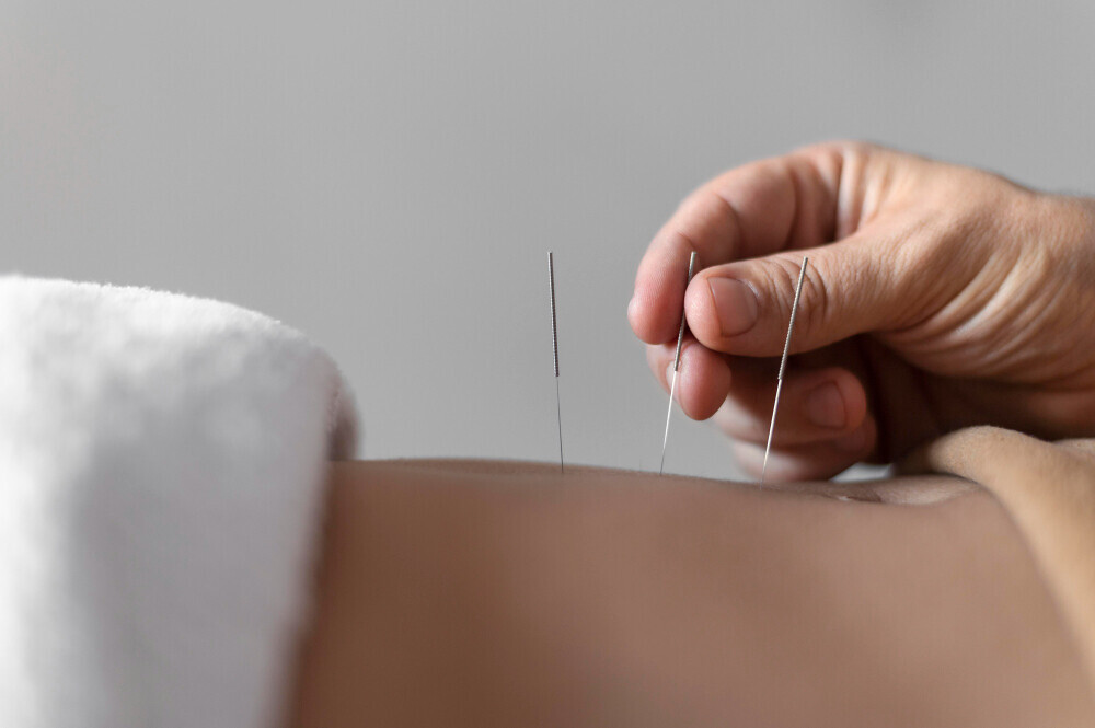 Acupuncture for Pain Relief  Powerful Proven Healing